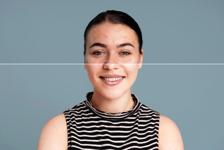 Benefits of Chemical Peels for Acne-Prone Skin