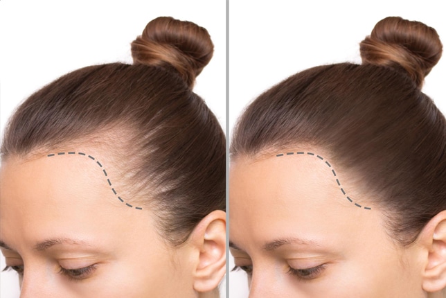 Regenera Activa Hair Restoration in Chennai