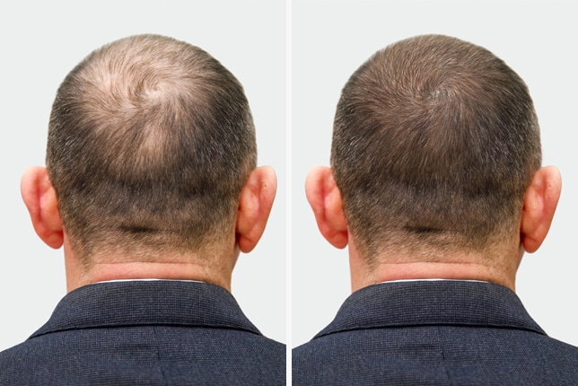 Regenera Activa Hair Restoration in Chennai