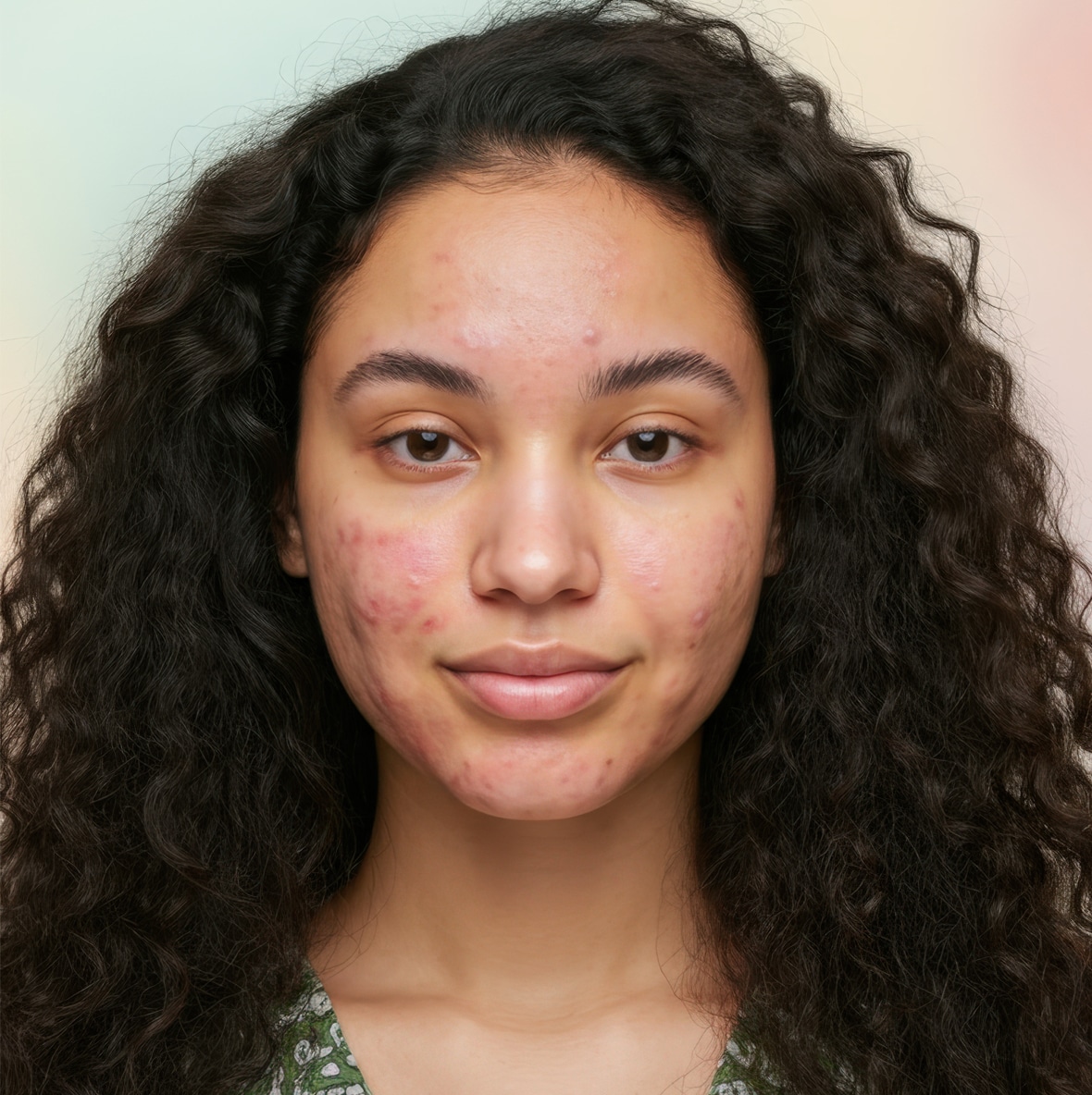 Acne-Scars-Anlon-1 Acne-Scars-Anlon-1