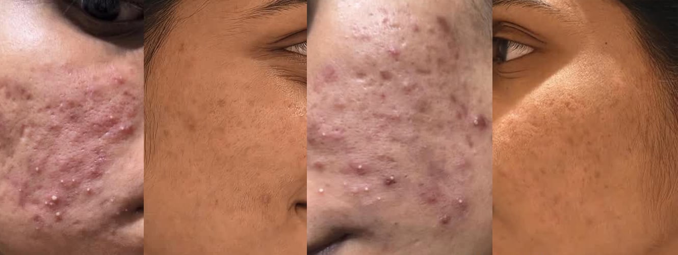 Anlon Laser Therapy to Acne Scars Advantages