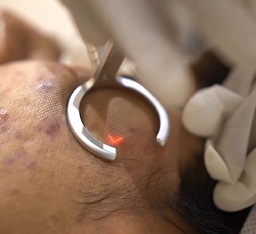 Anlon Laser Therapy to Acne Scars Advantages