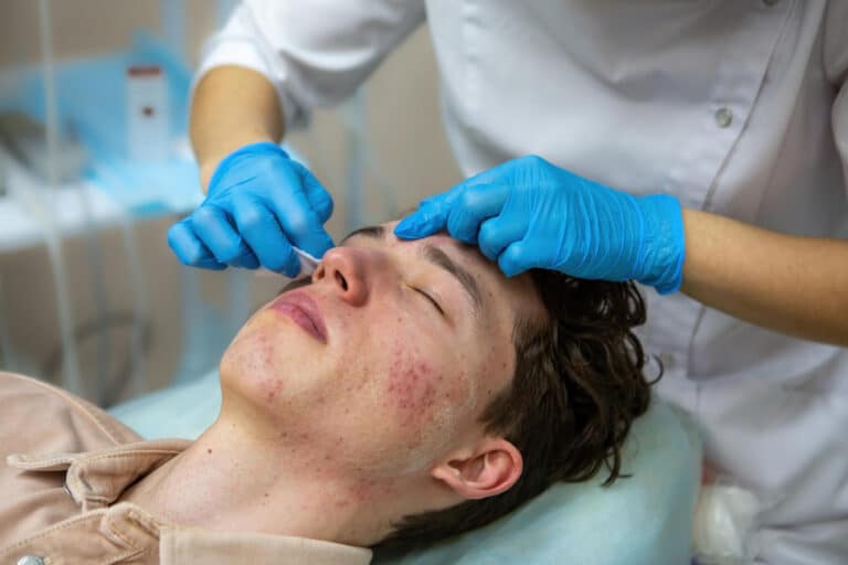 Best-Acne-Scar-Treatments-in-Chennai