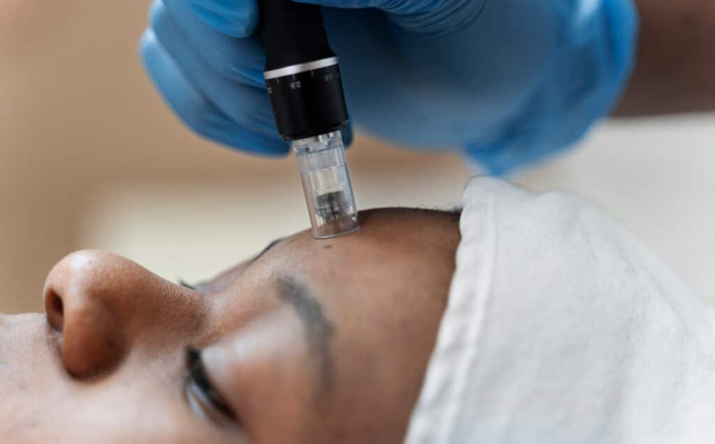 Microneedling Acne Scar Treatment