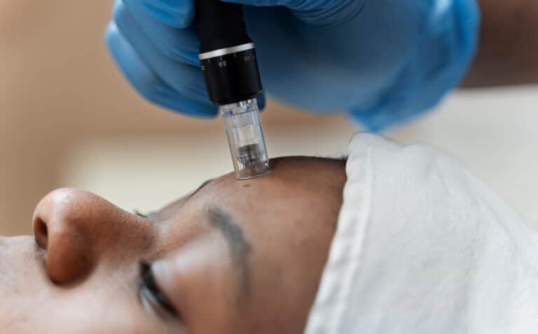 Microneedling Acne Scar Treatment