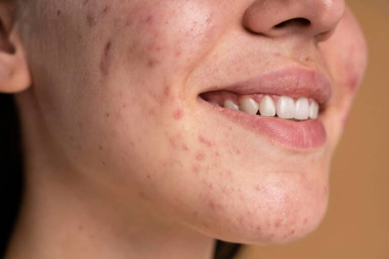Top Medical Treatments for Acne Scars
