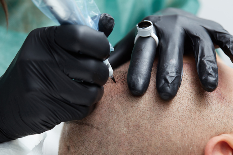Scalp Micropigmentation