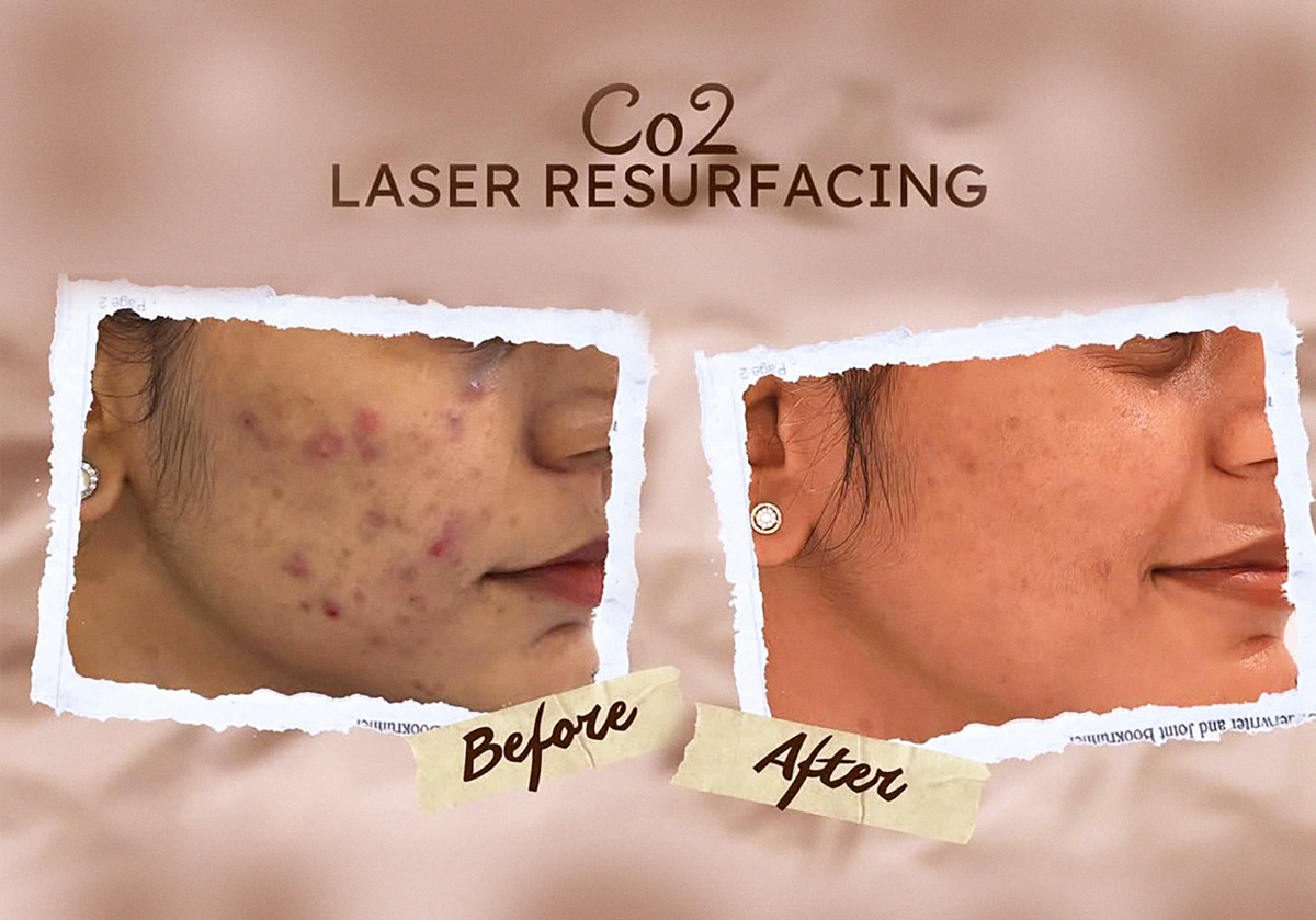 CO₂ Laser for Active Acne