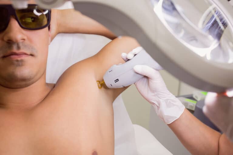 Underarm Laser Hair Reduction