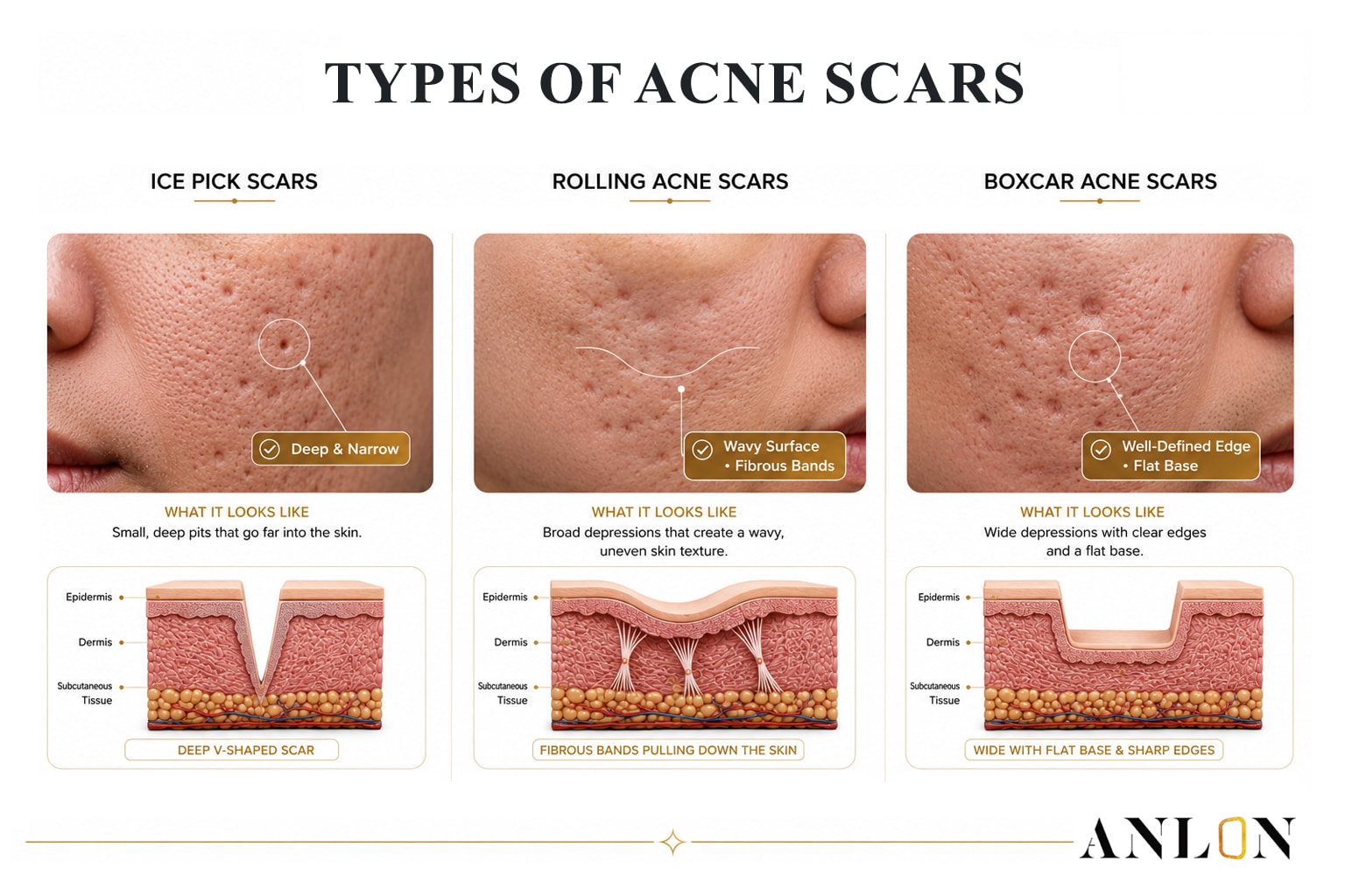 Different types of acne scars including ice pick scars, rolling acne scars, and boxcar acne scars