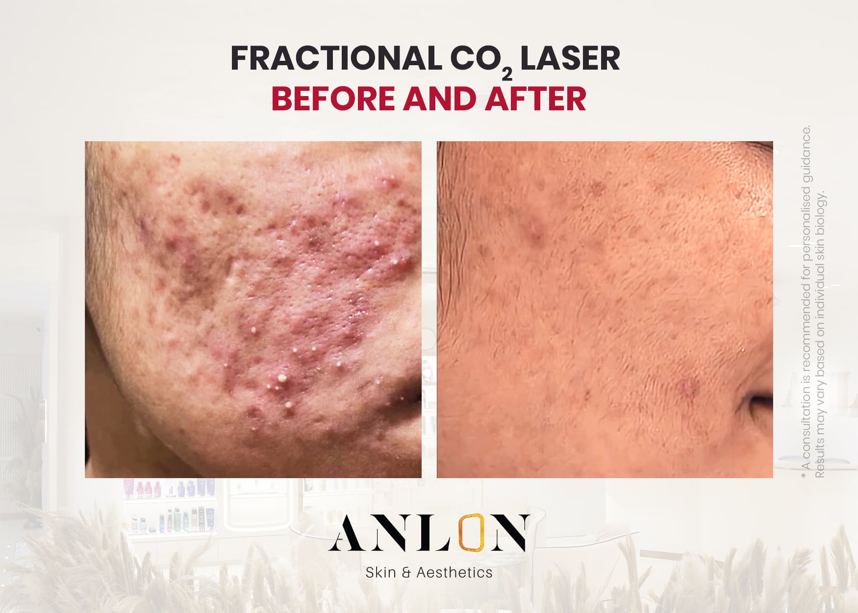 Fractional CO2 Laser
Before and after
