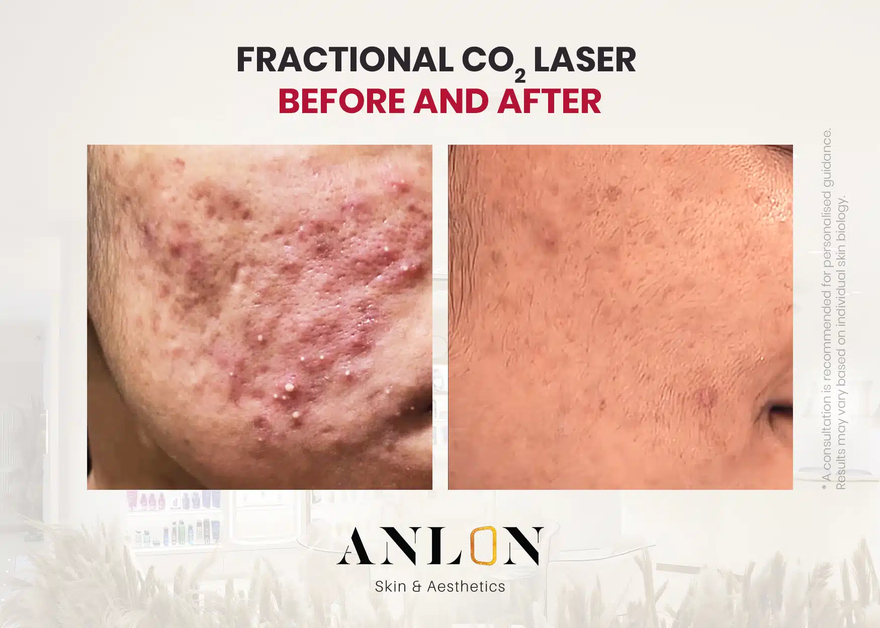 Fractional CO2 Laser Before and after